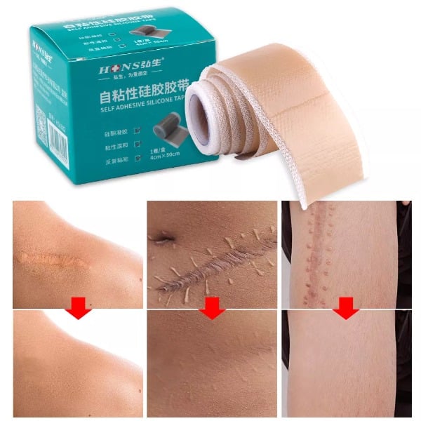 Surgery Scar Removal Silicone Gel Patch