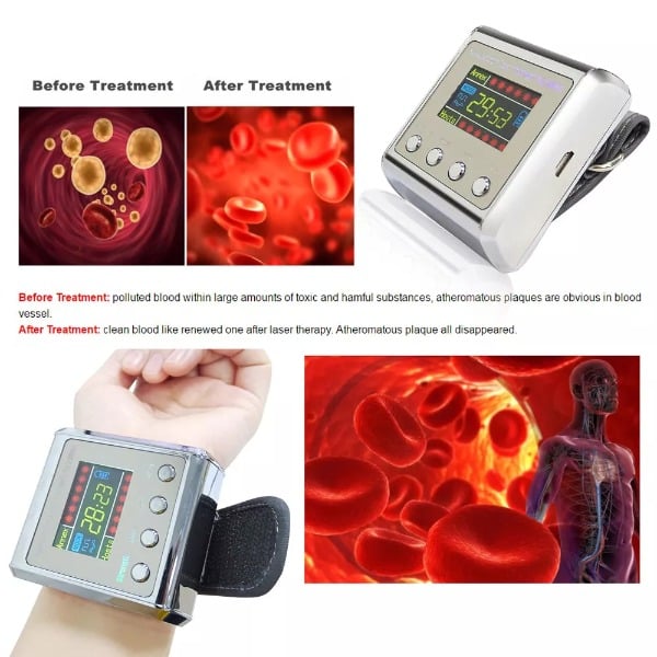 Hypertension Laser Therapy Watch