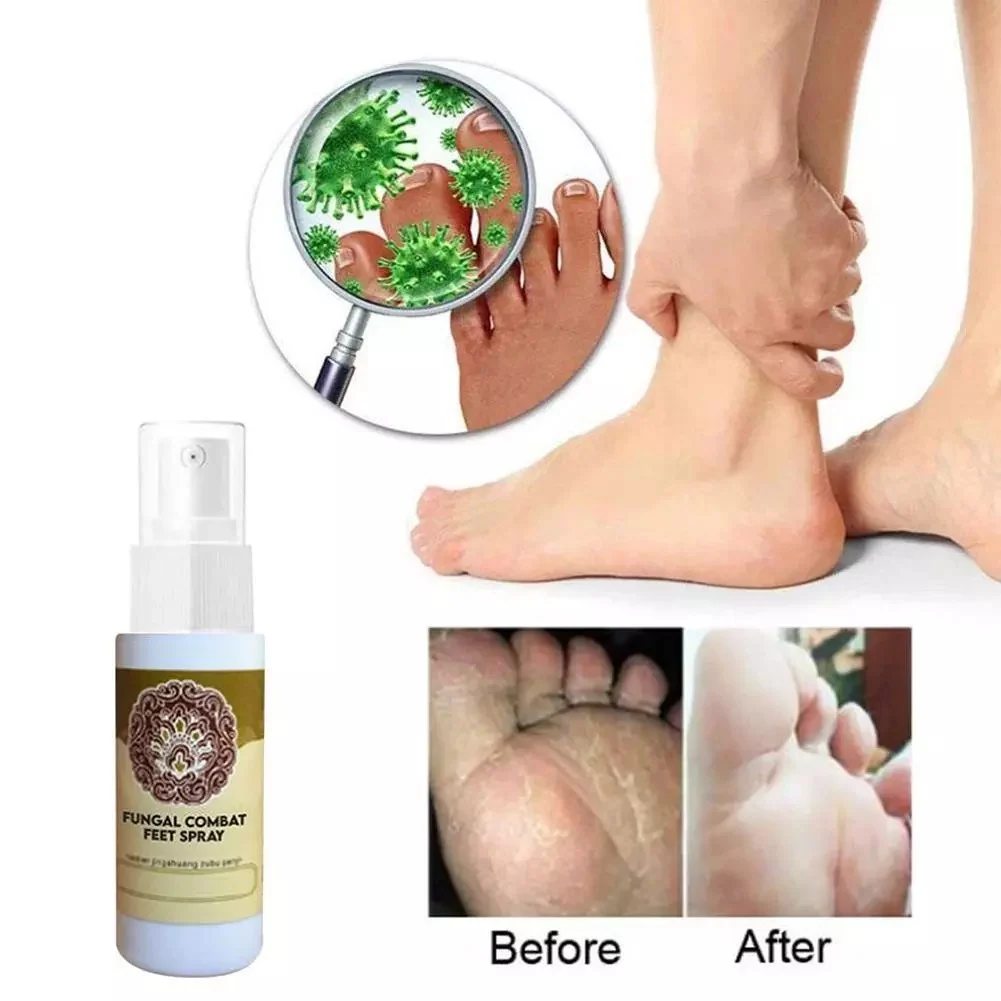 Antifungal Treatment Spray