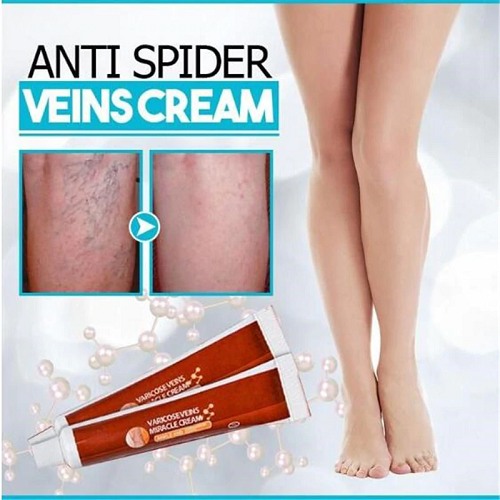 Varicose Veins Miracle Cream